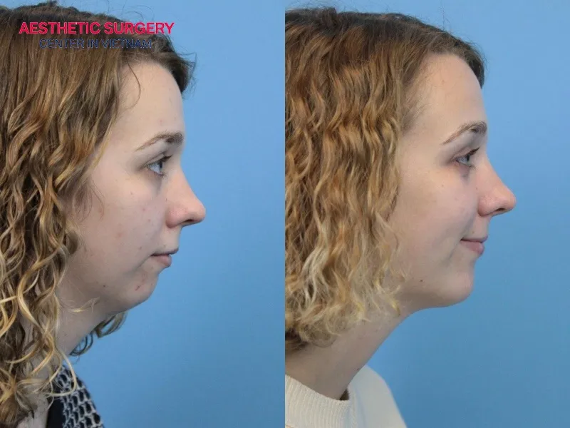 The appearance changes noticeably after the surgery.