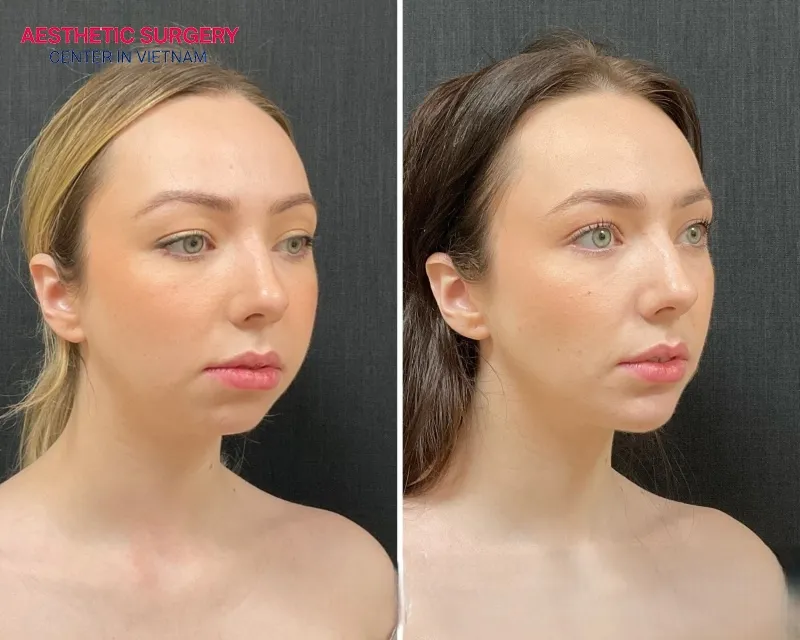 Facial contours become sharper and more striking after chin augmentation.