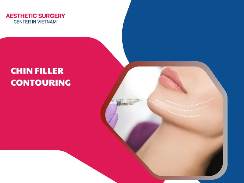 Chin filler contouring