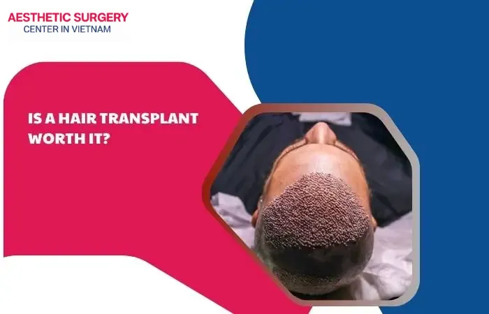 Is a hair transplant worth