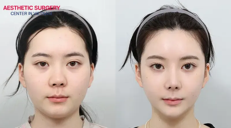 Impressive transformation after cheekbone reduction surgery
