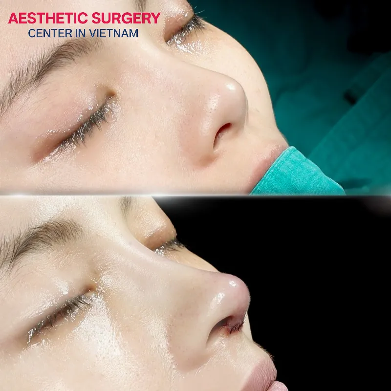 Rhinoplasty is one of the common facial contouring procedures.