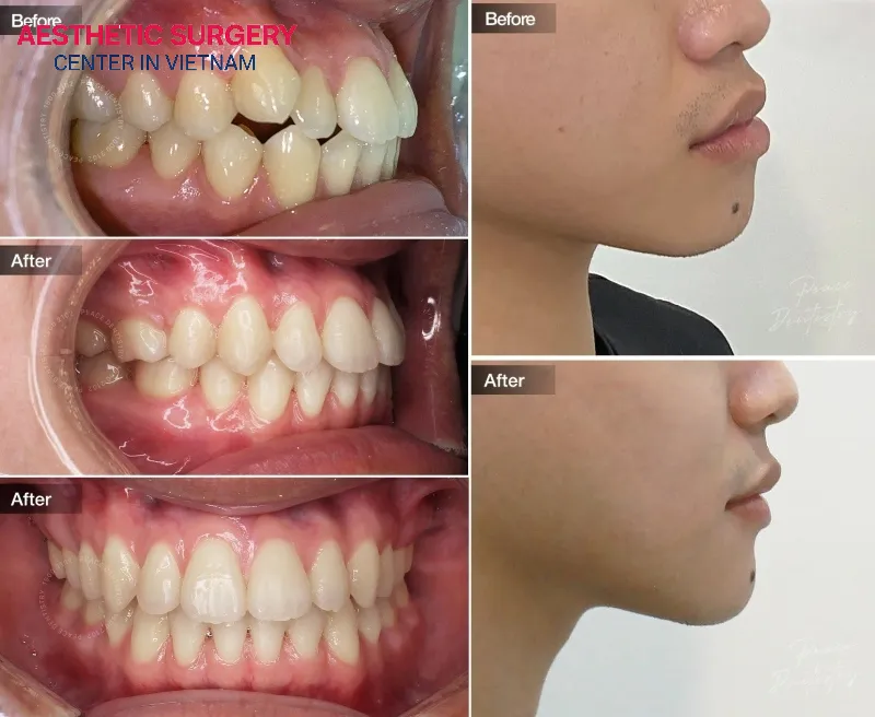 Individuals with congenital facial deformities are encouraged to undergo facial contouring surgery early.