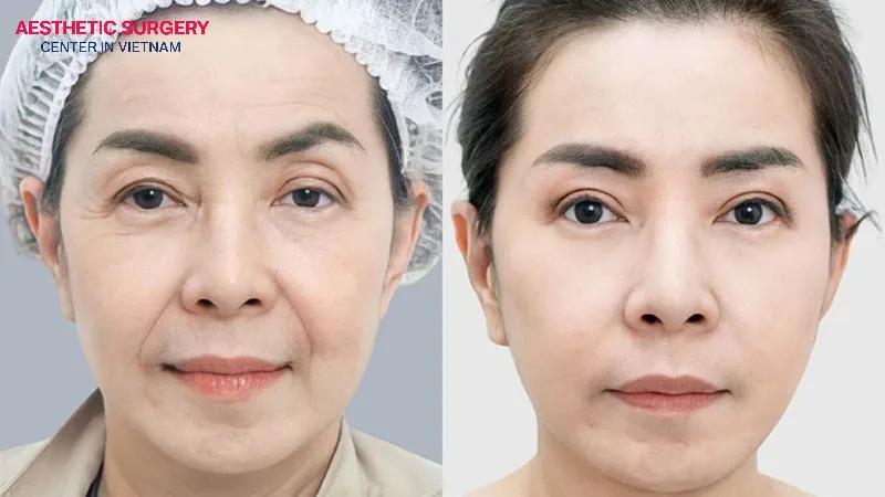 A facelift helps reduce visible signs of aging.