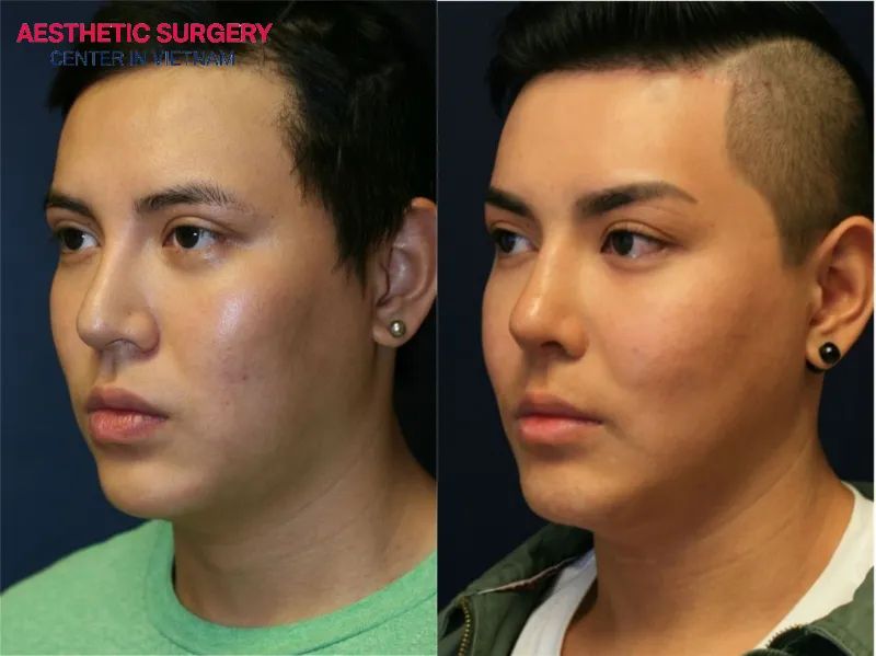 Chin augmentation helps improve facial proportions, making the face appear more balanced and harmonious.