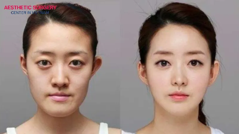 The face appears slimmer and more feminine after jaw reduction surgery