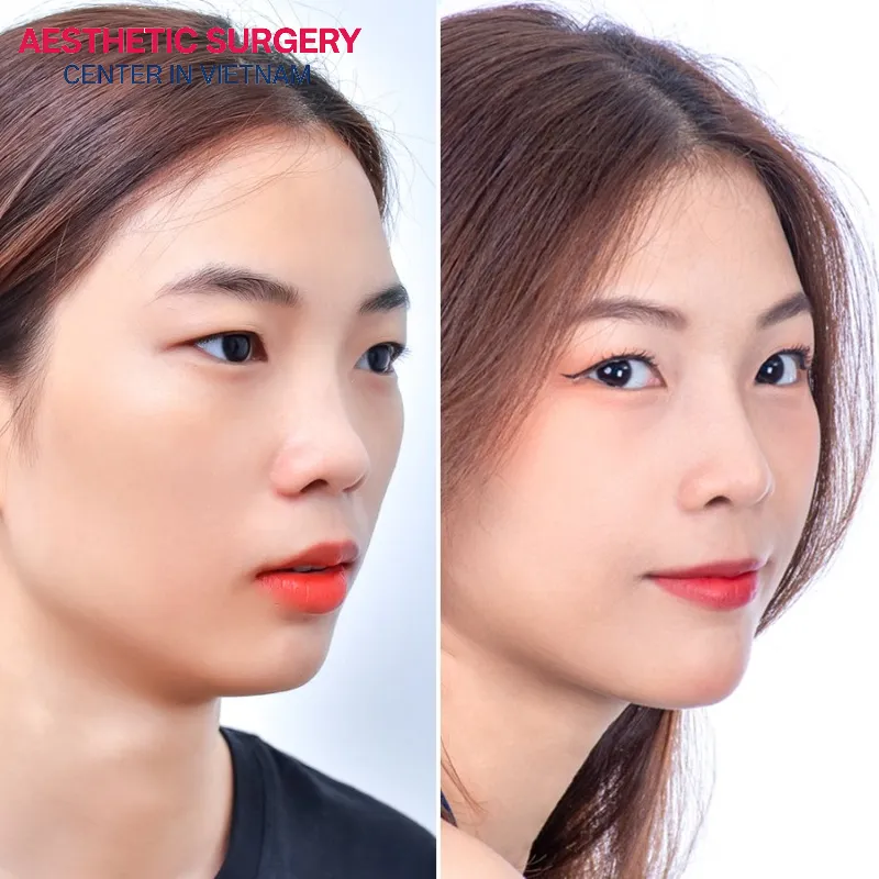 The nose becomes higher, more refined, and well-defined after surgery