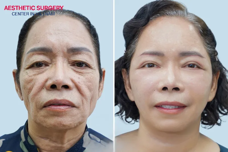 The client looks about 10 years younger after a facelift