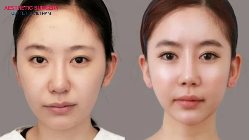 Results after double chin liposuction