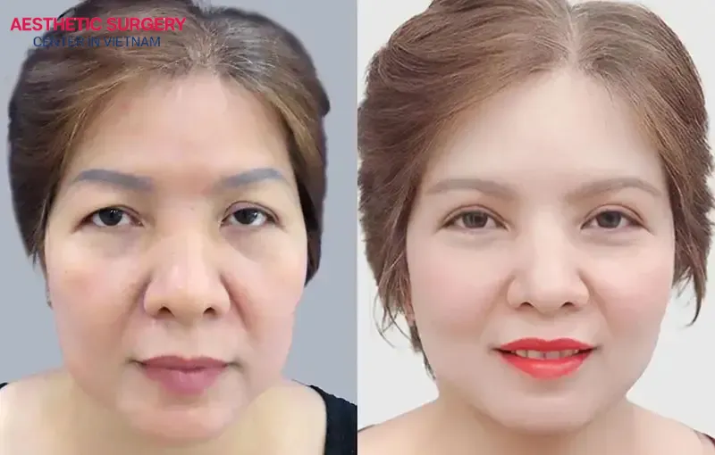 A Brow lift combined with eyelid surgery can be relatively costly, but it effectively addresses multiple facial concerns at once.