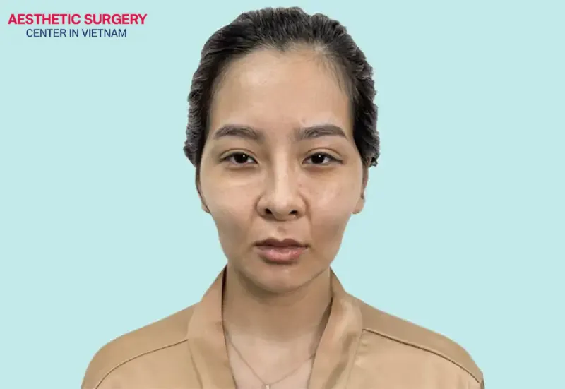 People with hollow, aged-looking faces, loose skin, and volume loss can also improve their appearance through a liquid facelift