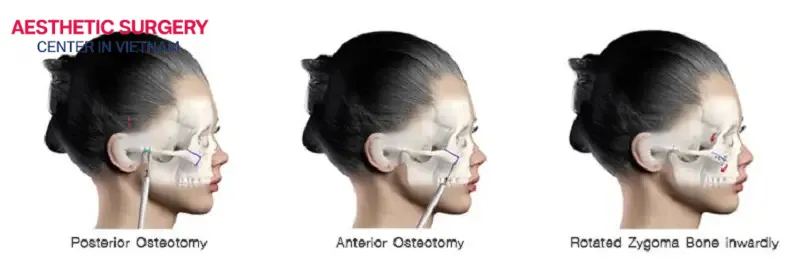 Cheekbone osteotomy surgery is a more complex procedure than cheekbone shaving/contouring surgery