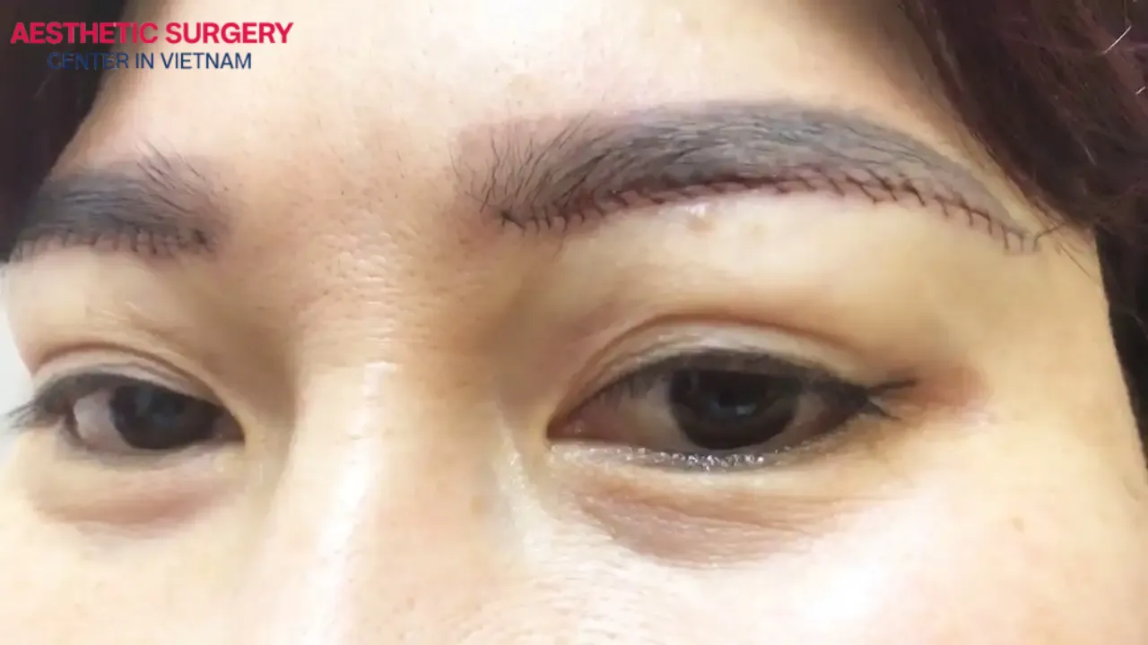 The average cost of a Brow lift in Vietnam ranges from 8 to 25 million VND, depending on the clinic, technique, and other factors.