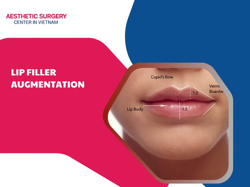 Lip Filler Augmentation