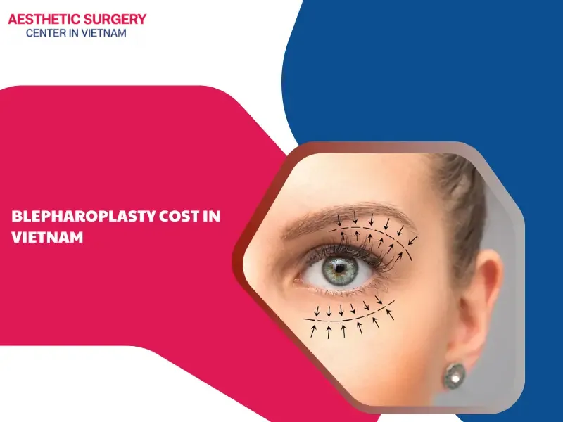 Blepharoplasty Cost in VietNam
