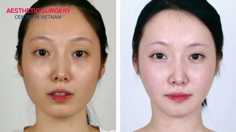 Mandibular angle reduction surgery aims to reshape the jawbone to create a slimmer and more defined facial contour.