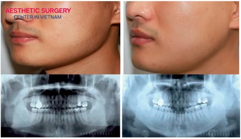 Mandibular angle reduction surgery provides permanent results.