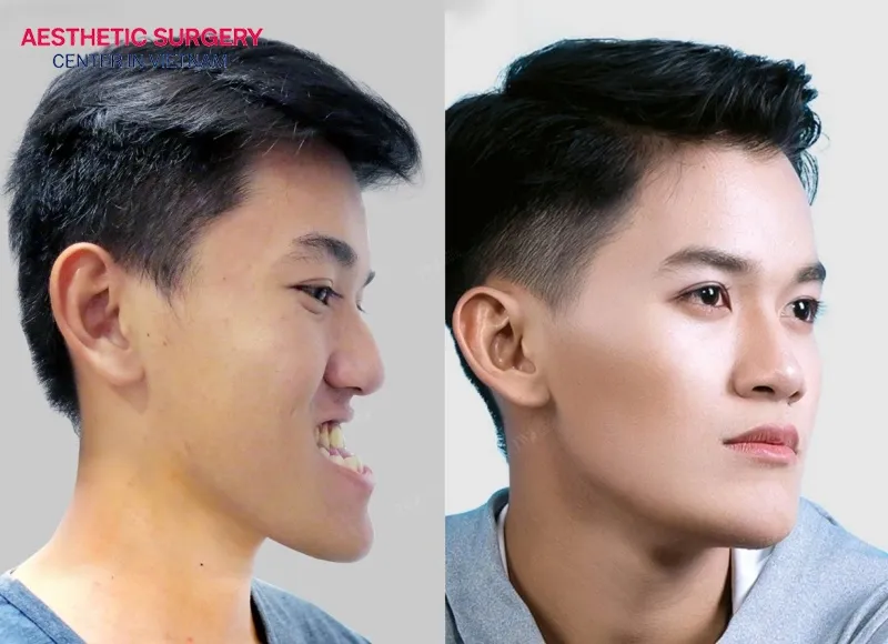 Post-surgery recovery requires adequate rest and healing time.