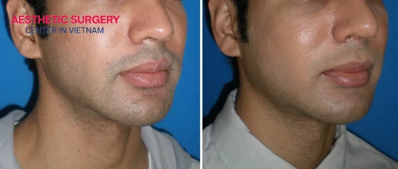 If you have a square or angular jawline, you can consider mandibular angle reduction surgery to enhance your facial appearance.