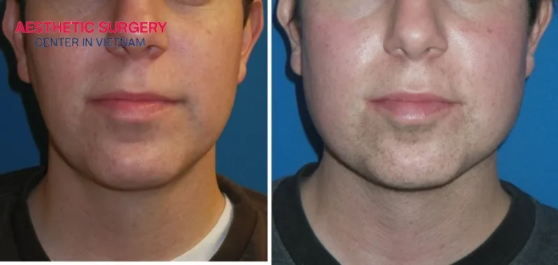 The cost of mandibular angle reduction surgery ranges from approximately 3,000 to 6,500 USD.