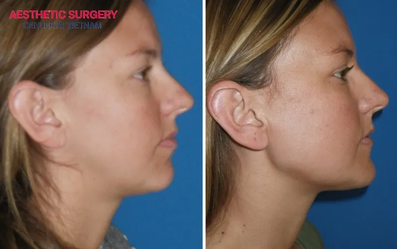 The lower jawline appears noticeably slimmer and more refined.