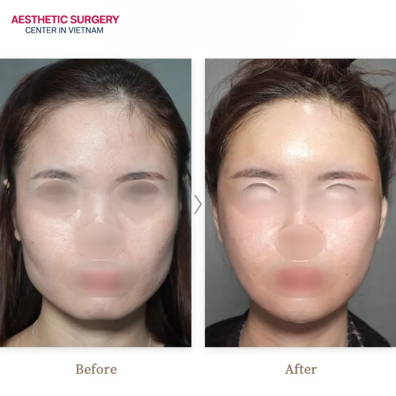 A remarkable transformation can be seen between the before and after of the mandibular angle reduction surgery.