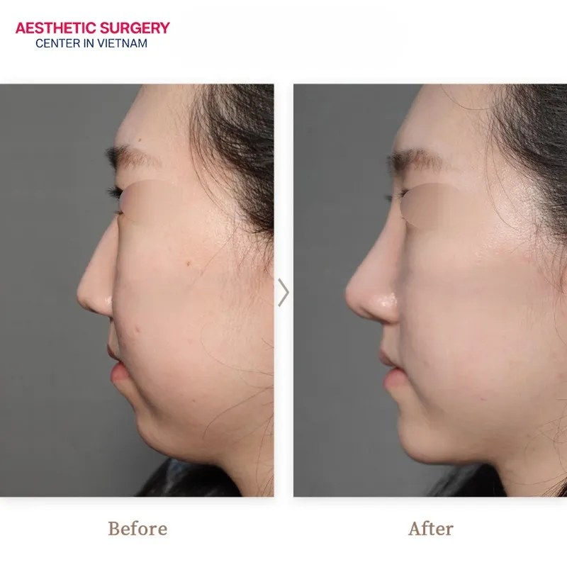 You can feel more confident about your appearance after refining your mandibular angle.