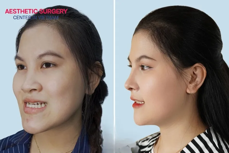 Your appearance is noticeably enhanced after the surgery.