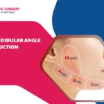 What is mandibular angle reduction surgery?