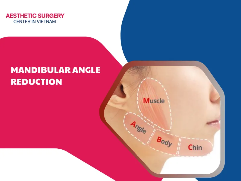 What is mandibular angle reduction surgery?
