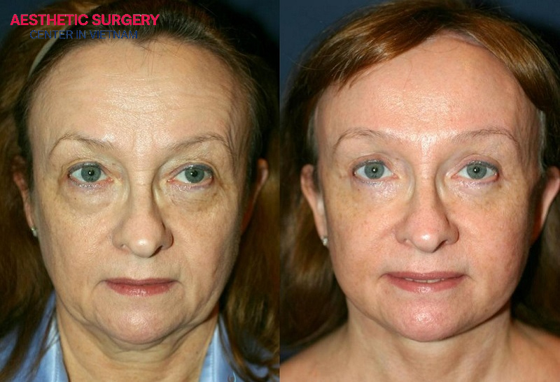 Eyelid surgery delivers long-lasting results for clients.
