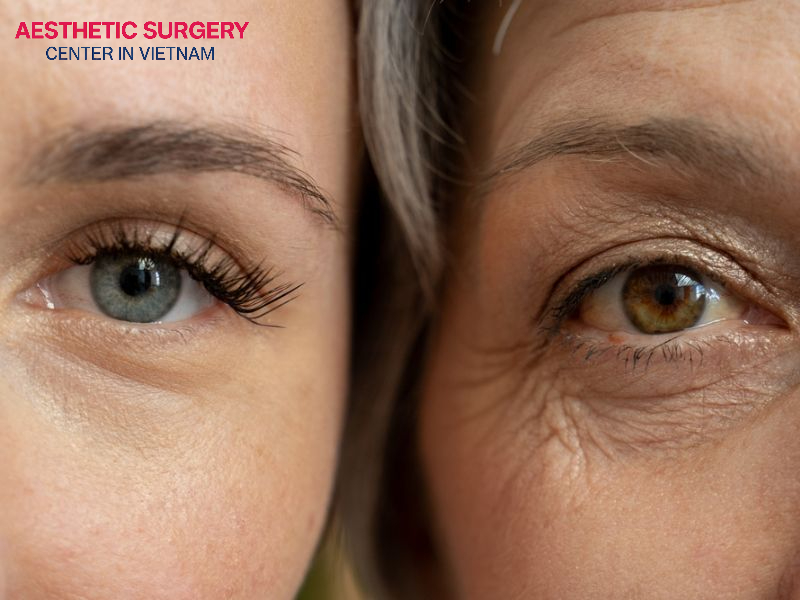 Those Showing Signs of Eyelid Aging Should Consider Eyelid Surgery
