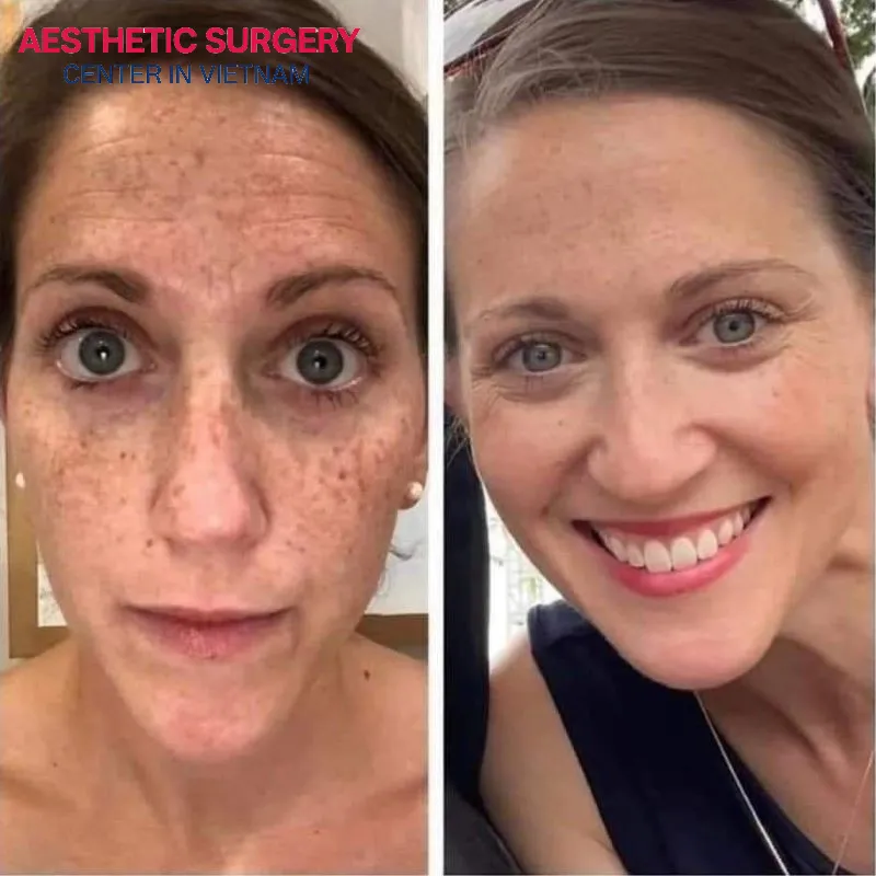 Clients’ skin becomes noticeably brighter, smoother, and more even-toned after just a few picosure laser sessions at Aesthetic Surgery Center.