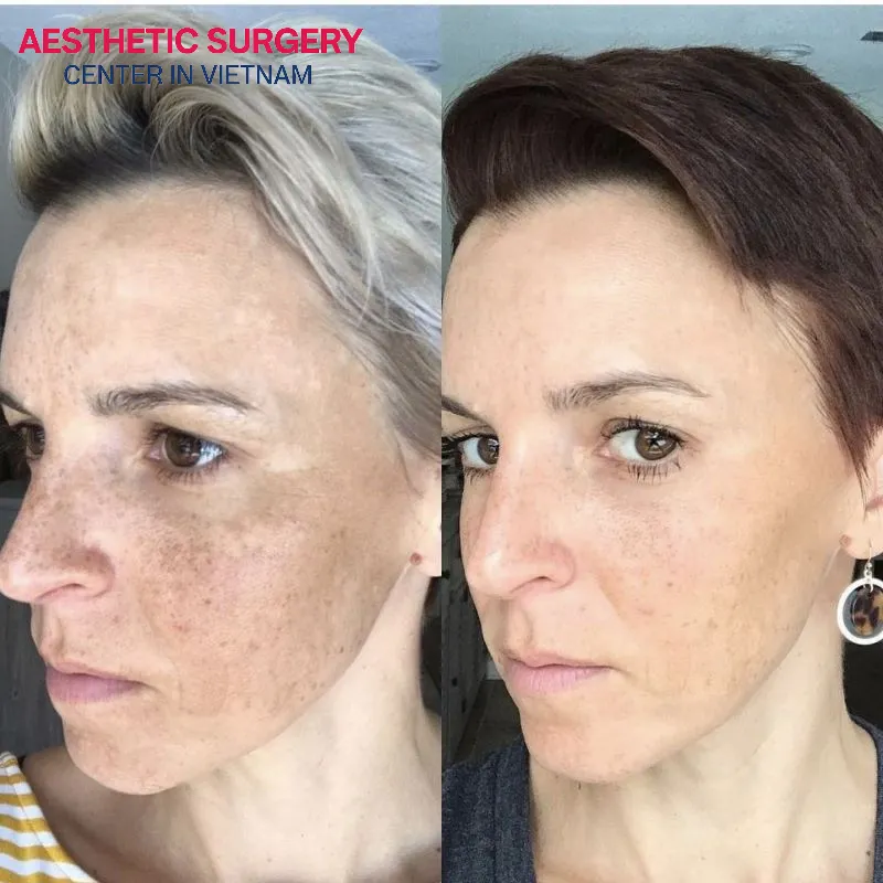 You will feel completely painless during the treatment and quickly achieve smoother, brighter skin after just a few sessions.