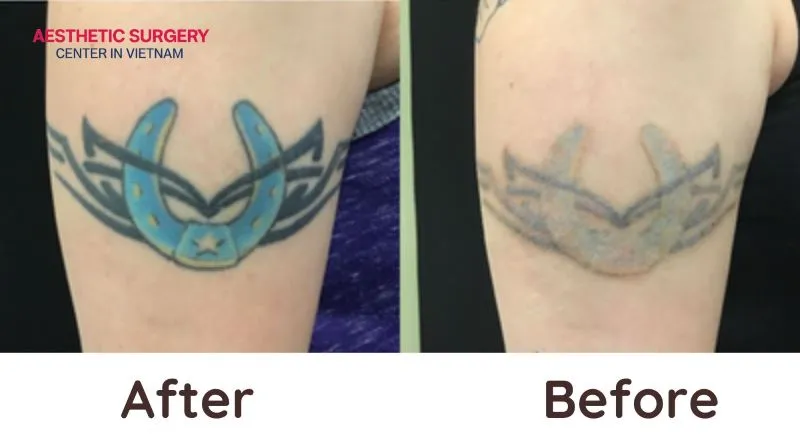 After just a few sessions, the tattoos on the skin have noticeably faded, and additional treatments can be performed to achieve optimal results.