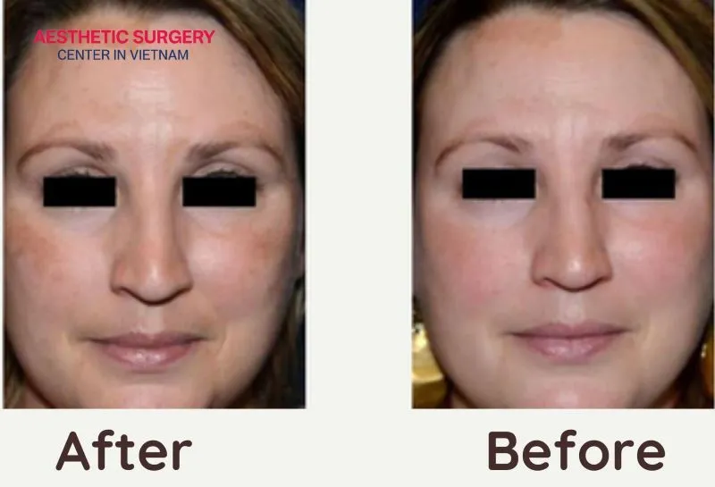 Clients’ skin shows a significant reduction in dark spots, melasma, and age spots after treatment at reputable clinics.