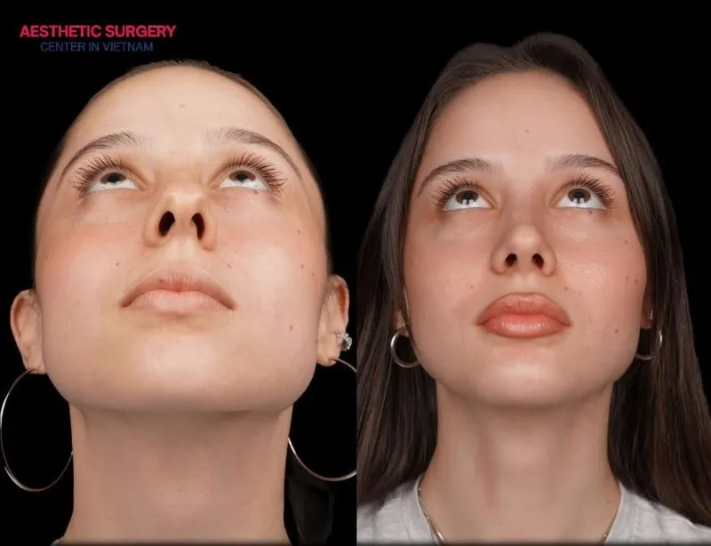 Aesthetic Surgery Center Vietnam successfully performed a structural rhinoplasty, helping the client gain confidence with a naturally beautiful nose shape.