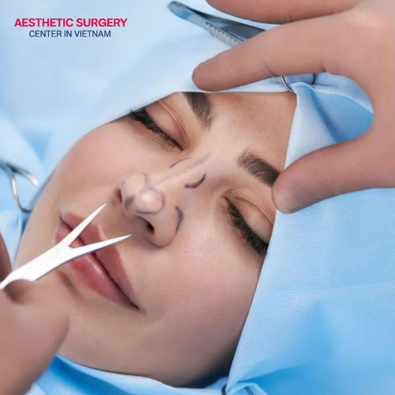 The structural rhinoplasty technique works on the entire nasal framework, helping to completely correct all nasal imperfections.