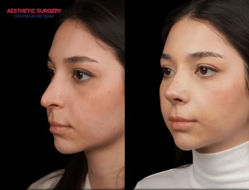 Creates facial balance, giving the nose a naturally high, straight, and more attractive appearance.