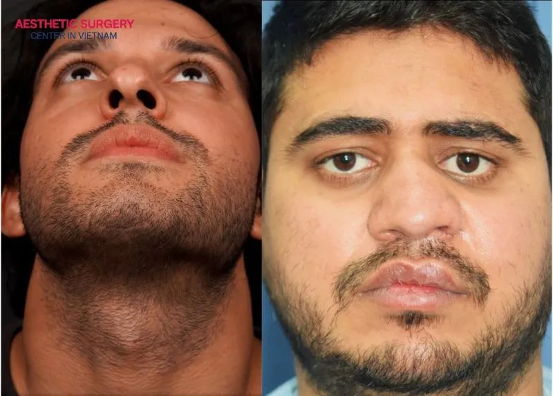 Individuals with a crooked nose or those whose nose has been damaged by previous surgery are suitable candidates for structural rhinoplasty.