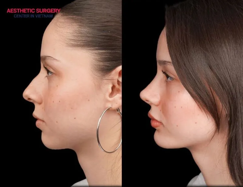 Client’s appearance after successfully undergoing structural rhinoplasty.