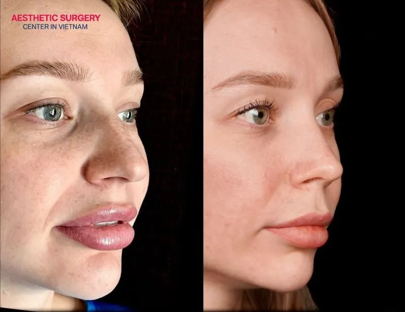 The face looks fresher and more attractive as the nasal framework has been completely restructured.