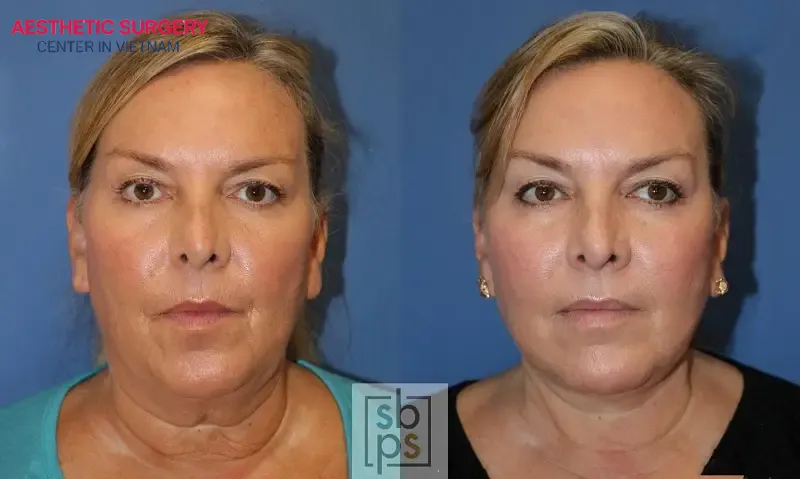 Image of a noticeably younger-looking woman after a facelift