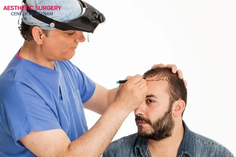 For individuals with significant baldness or hair loss, the doctor may recommend multiple transplant sessions spaced a few months apart to achieve the best results