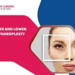 Upper and lower blepharoplasty