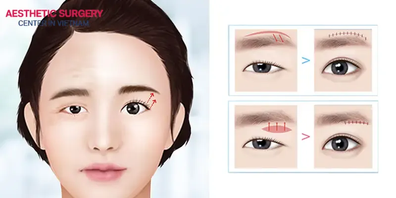 In Vietnam, Brow lift procedures are highly favored by women as an effective solution to correct sagging eyebrows.