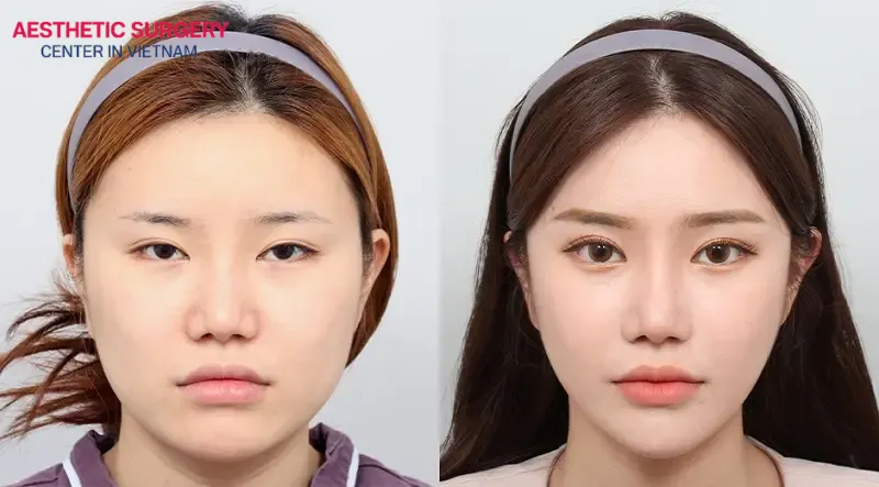 A girl’s face becoming more balanced, harmonious, and beautiful after cheekbone reduction surgery