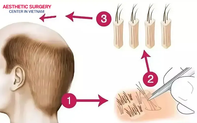 You will notice tiny marks in the areas where the follicles have been removed