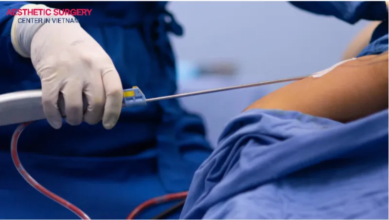 Arm liposuction is a method of removing excess fat from the arms to create slimmer contours and a more defined shape.