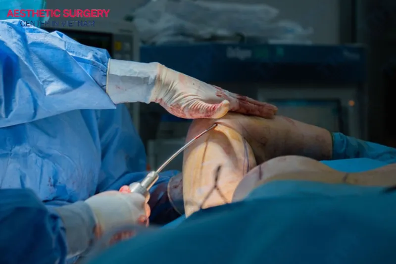An experienced surgeon is performing upper arm liposuction for the patient.
